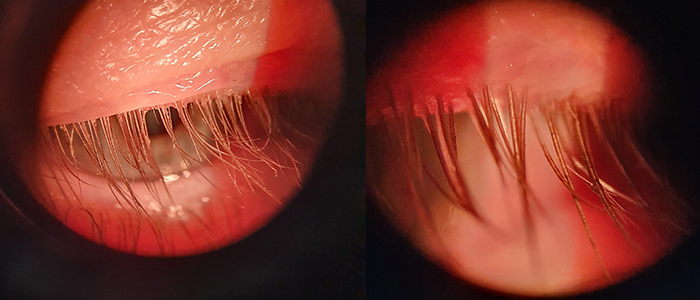 Links sind Wimpern vor der Behandlung mit dem AB-Max Lidreinigungsgerät. Rechts nach der Reinigung. Man sieht rechts keine gelbliche Schuppen und Ablagerungen mehr.